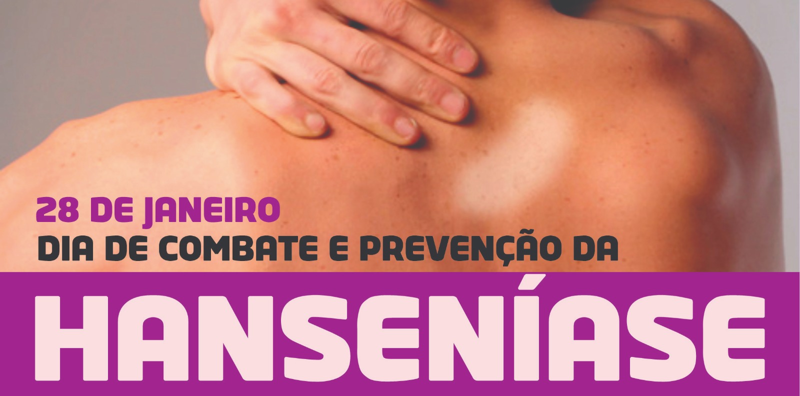Hanseníase