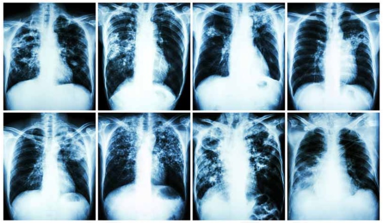 Tuberculose